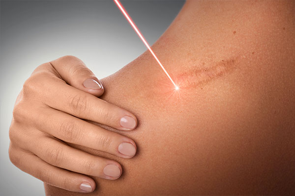 Medicina estetica: con il laser si sono aperte nuove frontiere. Trattamenti per lentigo, iperpigmentazioni, per rimuovere tatuaggi o per l